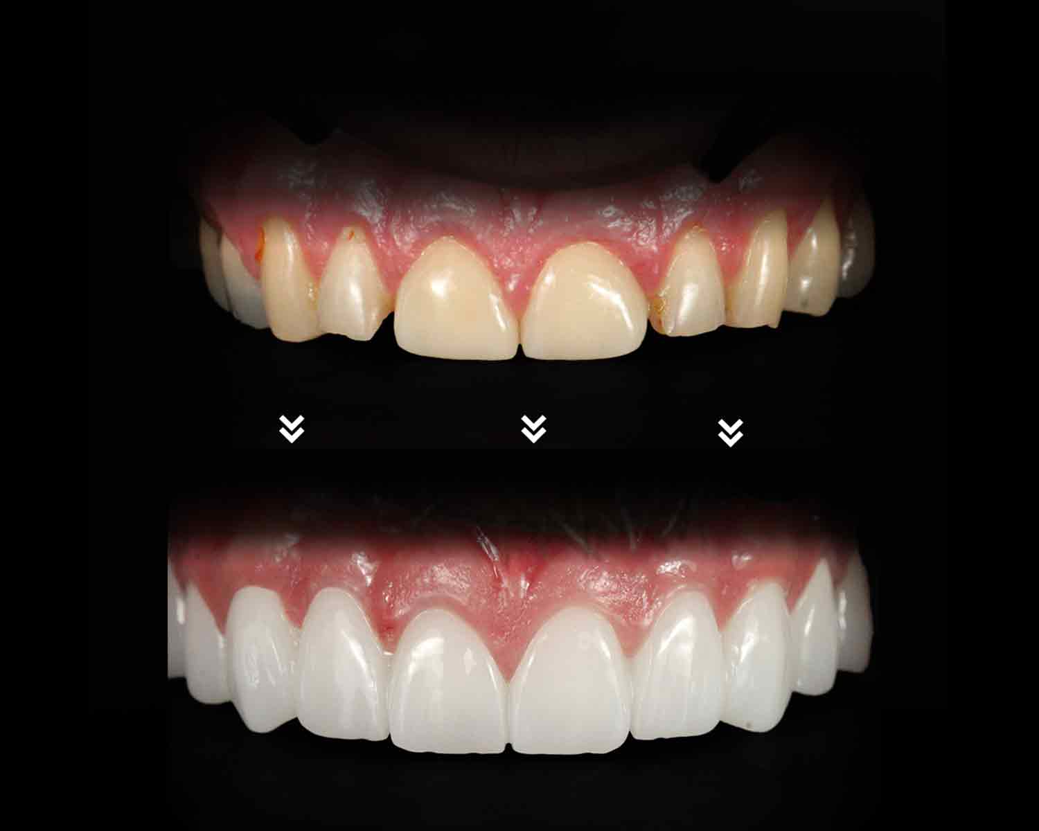 b-a-cover-denta-antalya