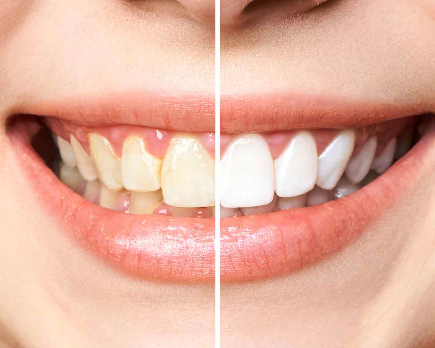 teeth-whitening-denta-antalya-1