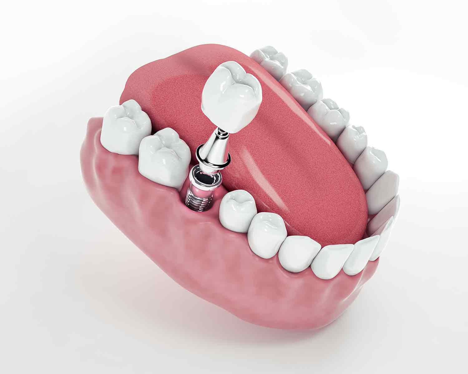 debtal-implant-Why-is-it-Preferred