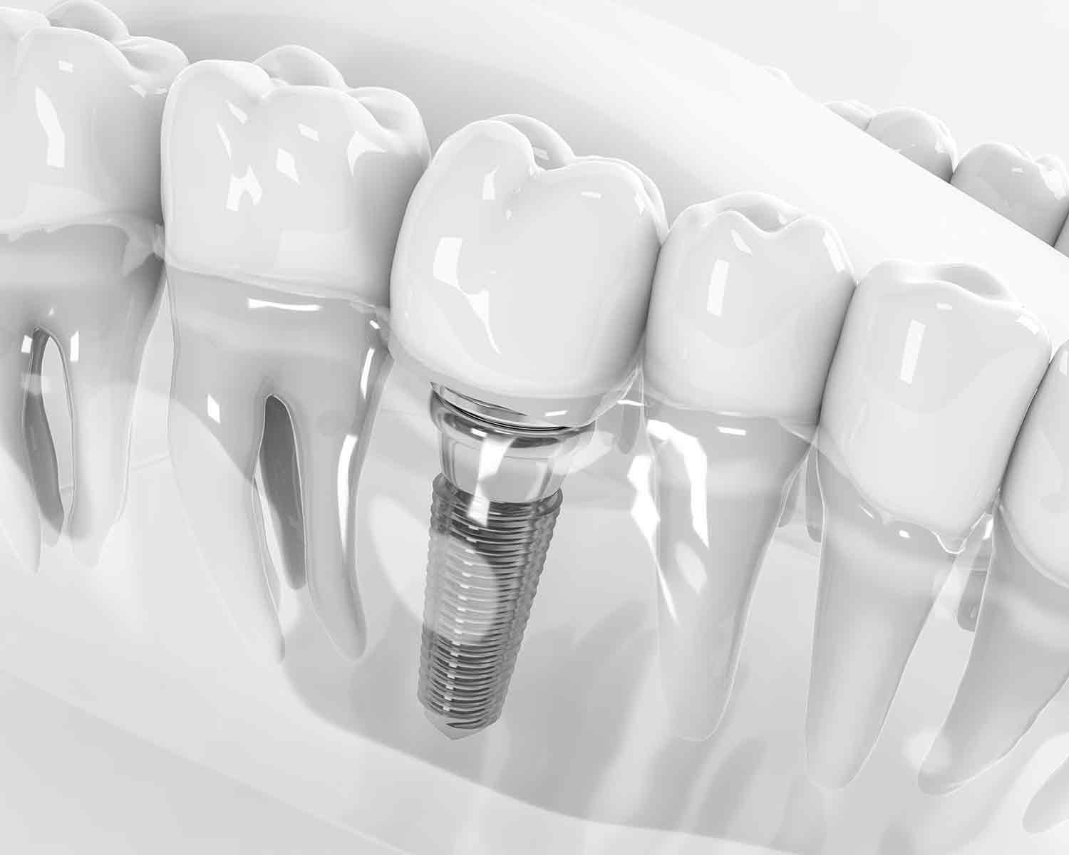 Advantages of Dental Implant Treatment in Antalya
