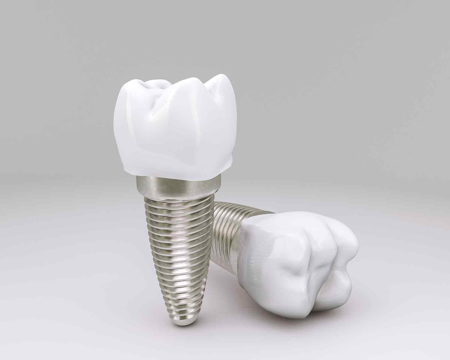 Factors Affecting Dental Implant Costs