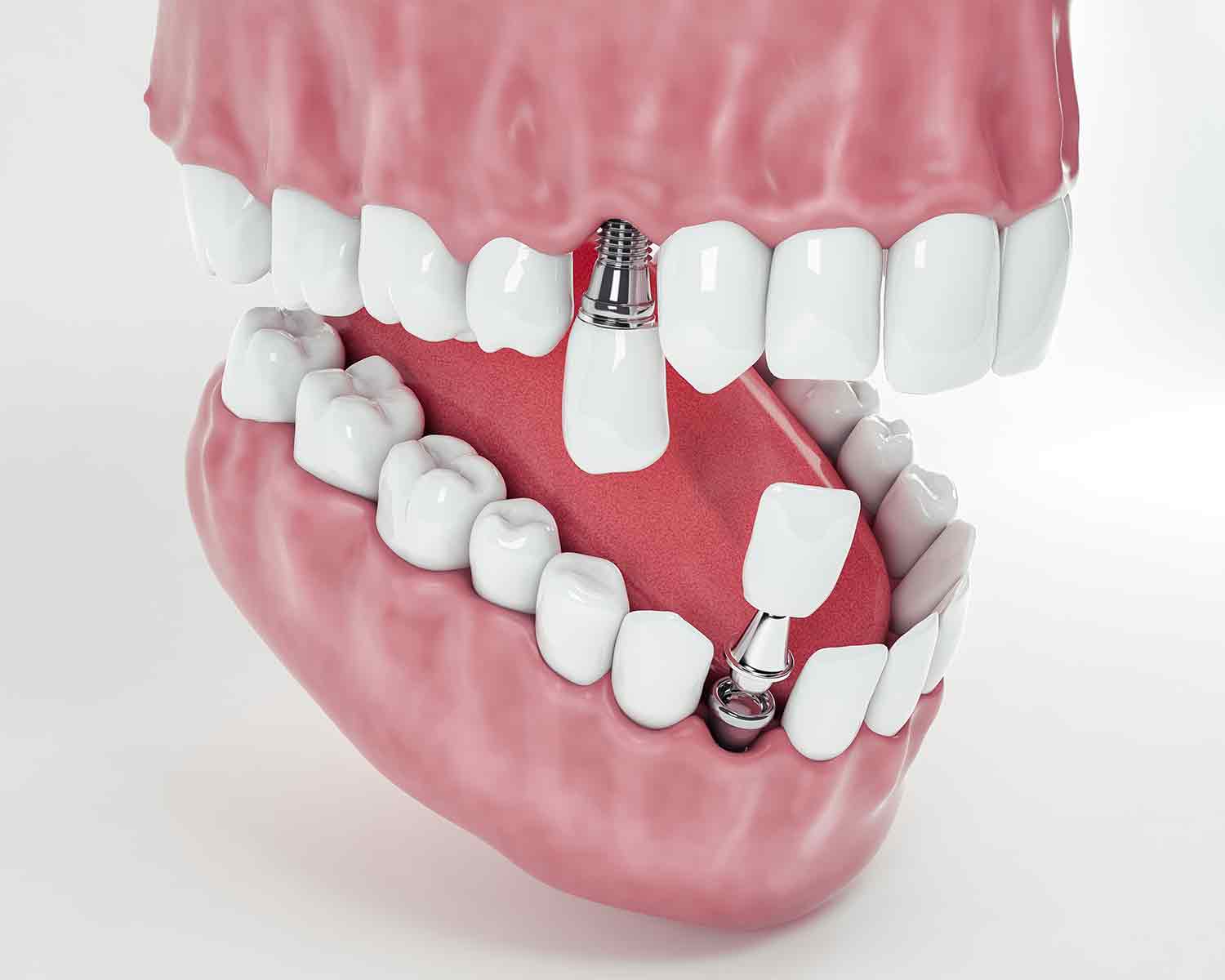 What Should Be Considered After Dental Implants?