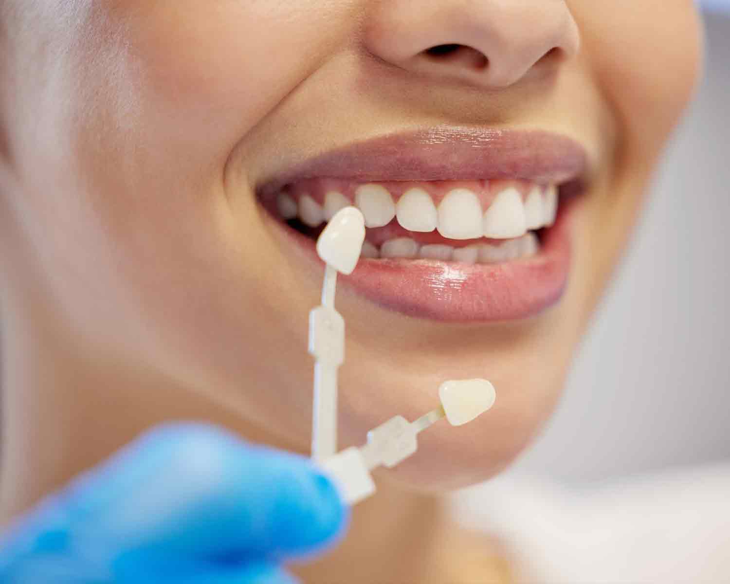 dental-veneers-denta-antalya-3