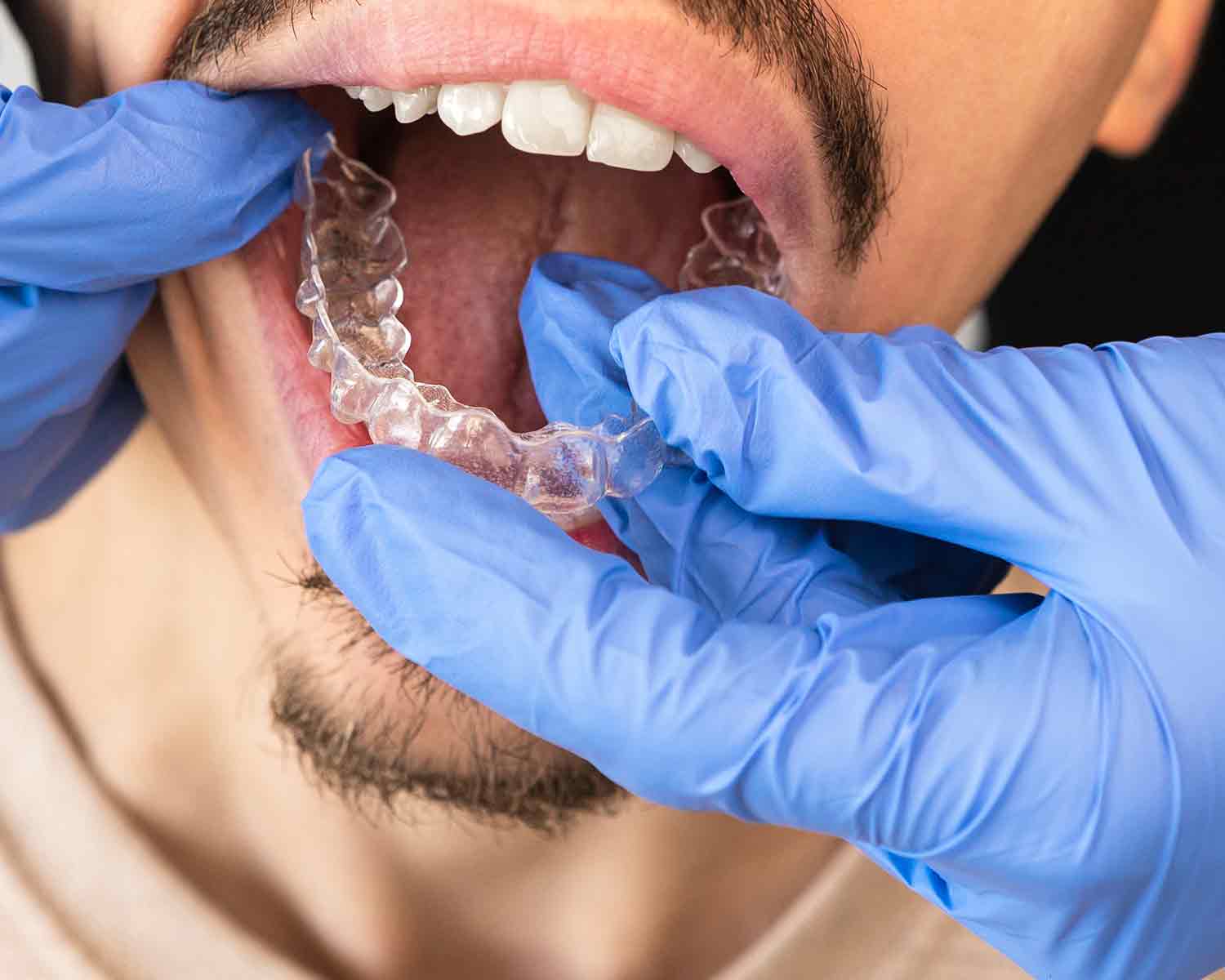 invisalign-denta-antalya-5