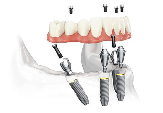debtal-implant-Why-is-it-Preferred