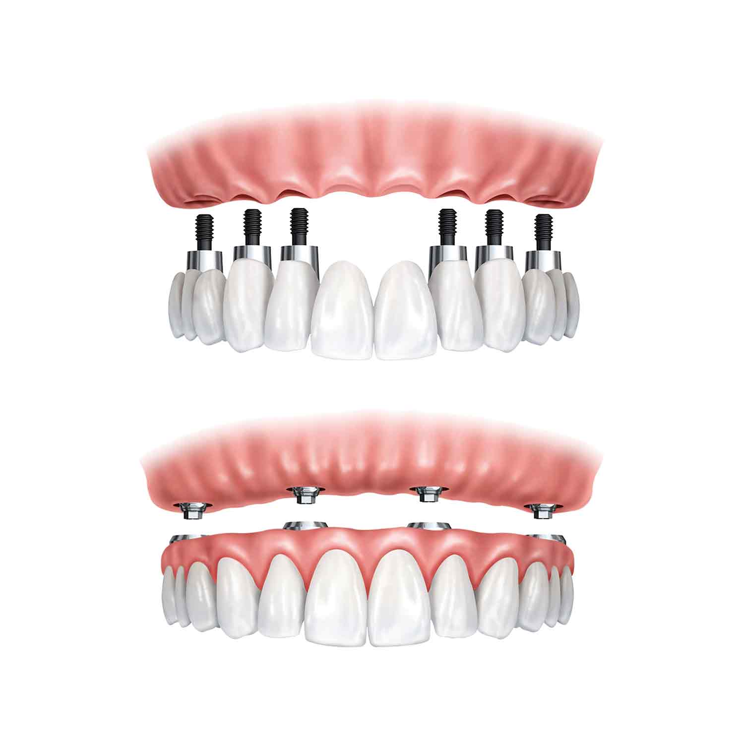 What Should Be Considered After Dental Implants?