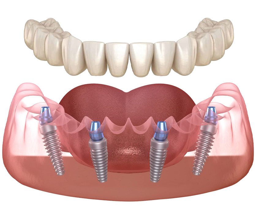Dental Implant